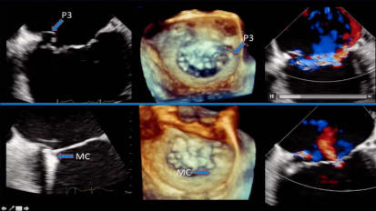 Valvular Regurgitation: Evaluation by Echo & MRI - Part 1 of 2