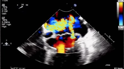 Valvular Regurgitation: Evaluation by Echo & MRI - Part 2 of 2