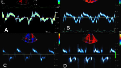 Echocardiographic Assessment of LV Diastolic Function