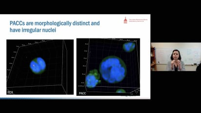 Urology Speaks: Ecology Meets Cancer Biology: Defining the Keystone Cancer Cell Species to Develop a Cure