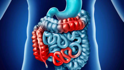Crohn's Disease in a Pediatric Patient