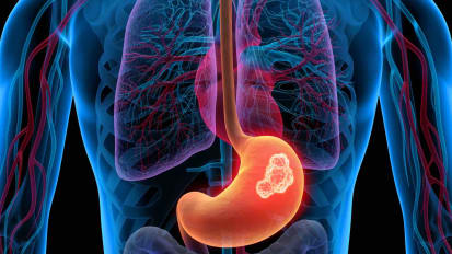 Case Presentation: Hereditary Diffuse Gastric Cancer