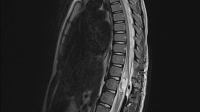 Case Presentation: Resection of Intradural, Intramedullary Capillary Hemangioma Dermal Sinus Tract