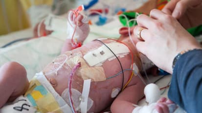 Patent Ductus Arteriosus in Preterm Infants