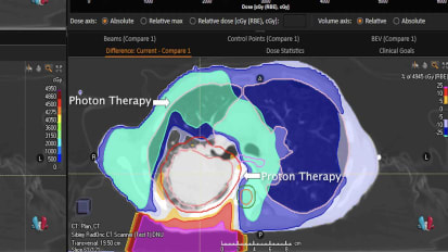 Advances in Radiation Oncology: Proton Therapy for Lung Cancers