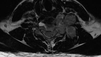 Case Presentation: Three-Staged Approach to Treatment of Pathologic Fracture Due to Giant Schwannoma at C6-7