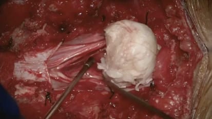 Case Presentation: Spinal Epidermoid Tumor