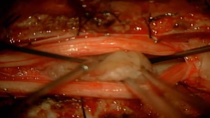 Case Presentation: Resection of Large Pediatric Spinal Cord Tumor