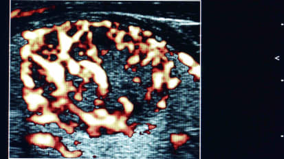 放射性频率反射贝宁甲型结核