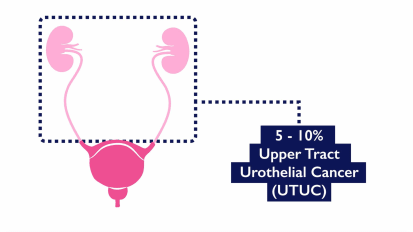 Upper Tract Urothelial Cancer