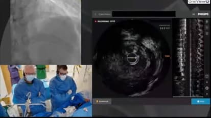 Case review of IVUS-guided PCI of a bifurcation lesion 