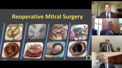 Reoperative Mitral Valve Surgery: Current and Future Realities
