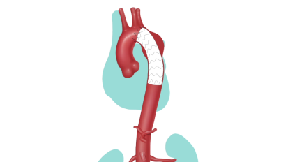 Thoracic Endograft: Relining the Aorta to Prevent Rupture of a Thoracic Aneurysm