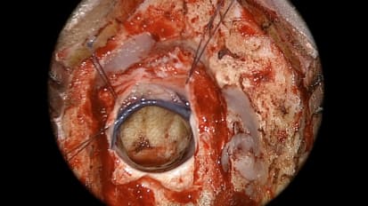 New Techniques for Treating Secondary Effects of Intracerebral Hemorrhage Stroke