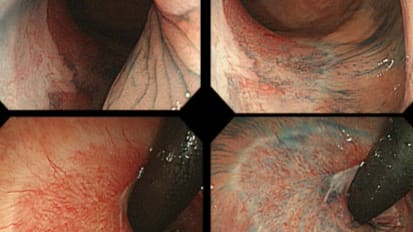 Colon ESD: Lesion assessment and technique