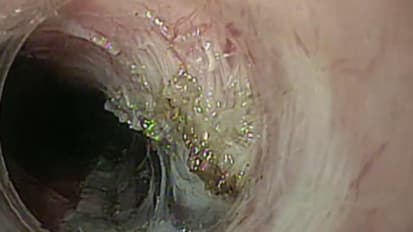 2016 LI Live: Morning Live Endoscopic Procedures