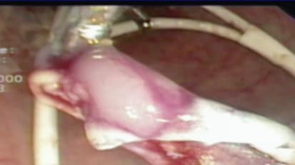 Advanced Techniques and Technologies in the Colon: From Visualization-Balloon-Assisted Colonoscopy to Colonic ESD