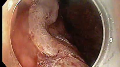 2016 LI Live: Afternoon Live Endoscopic Procedures