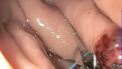 2015 LI Live Endoscopy Course: Live Morning Cases 2