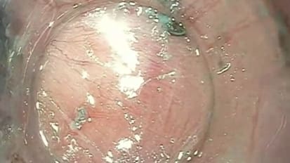 2015 LI Live Endoscopy Course: Afternoon Live Procedure