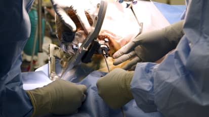 Laser Ablation for Controlling Seizures in Temporal Lobe Epilepsy