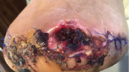 New Bite Sized Education: Snapshot: Dehisced Total Metatarsal Amputation Wound