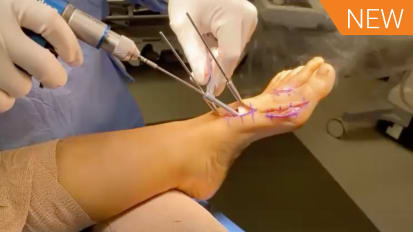 LapiFuse™: Link Between Patients and Surgery with Drs. W. Hodges Davis and Christopher Hyer [AP-013899A]