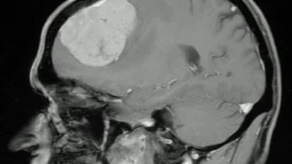 Penn Medicine’s John Y.K. Lee, MD, MSCE, discusses TumorGlow™