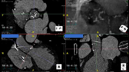 Low-Flow, Low-Gradient Aortic Stenosis