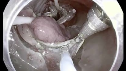 DiLumen C2 (with flexible endoscopic grasper) and colonic ESD procedures