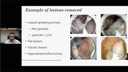 Reimbursement for Complex Endoscopic Resection, Navigating the Tortuous Road