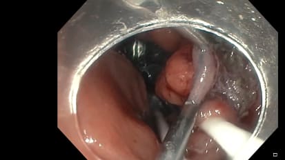 ESD with DiLumen® Provides Traction at the Splenic Flexure