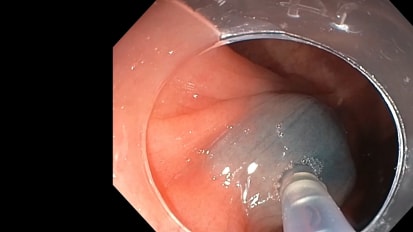 DiLumen® Proporciona Estabilidad en una Lesión Difícil en Àngulo Hepático