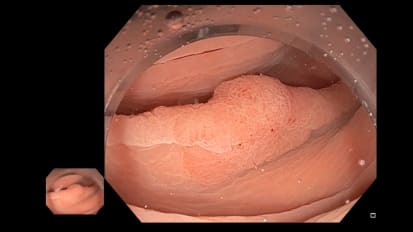 DiLumen® crea una zona terapeútica que facilita la URME