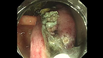 Bidirectional Traction in Colorectal ESD