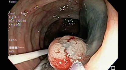 Clinical Experience with DiLumen: Polyp Resection via EMR at the Splenic Flexure