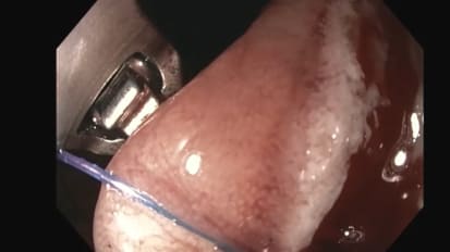 Experience Using DiLumen® with Overstitch for ESD in Right Sided Colon