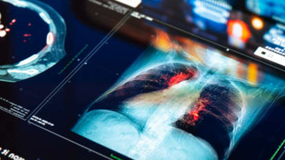 Lung Cancer Screening and SPN in the Patient with COPD