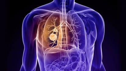 Why millions of Americans should be screened for lung cancer