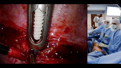 Anterior vertebral body tethering: A thoracoscopic fusionless procedure for skeletally immature patients with scoliosis