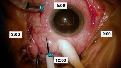 Surgical repair of chronic vitreous hemorrhage