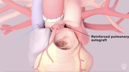 Cardiovascular surgery at Mayo Clinic - the Ross procedure