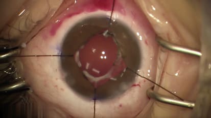 Right medial rectus recession followed by secondary intraocular lens insertion with iris hooks and optic capture