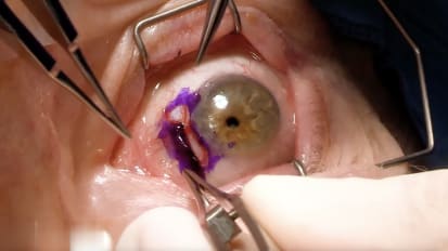 Bilateral limbal medial rectus hang-back recession with adjustable suture 