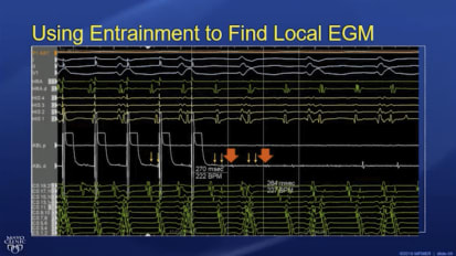 Heart Rhythm Webinar Series: Challenging case discussion with Mayo Clinic experts — IART