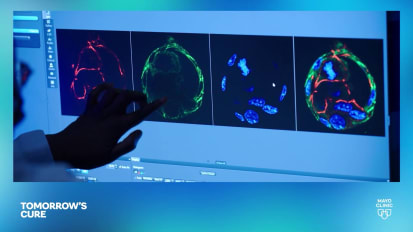 Could milk-derived nanoparticles change bile duct cancer care?