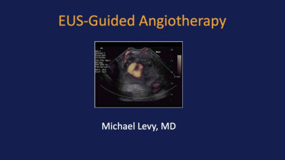 Endoscopic ultrasound-guided angiotherapy