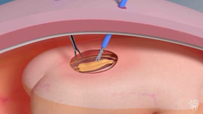 Spina bifida treatment using fetoscope