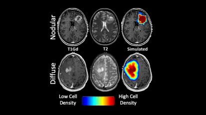 Pioneering glioblastoma care and treatments