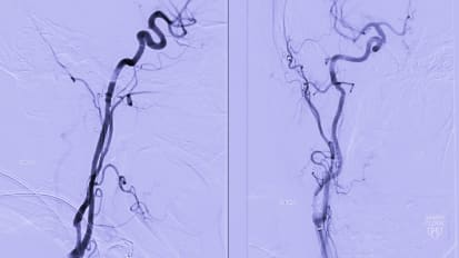 Carotid artery with stenosis — Diagnostic and treatment advancements